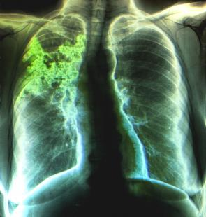Haiti/ Santé: plusieurs cas d'hospitalisation liés à l'insuffisance respiratoire resencés dans le Sud