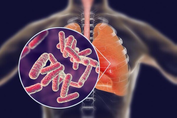 Haiti/ Santé: plusieurs cas d'hospitalisation liés à l'insuffisance respiratoire resencés dans le Sud